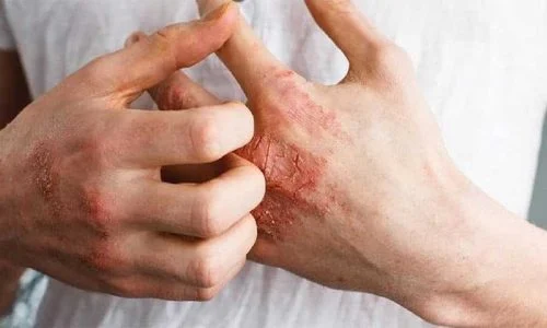 قهوه گانودرما برای بیماری پسوریازیس