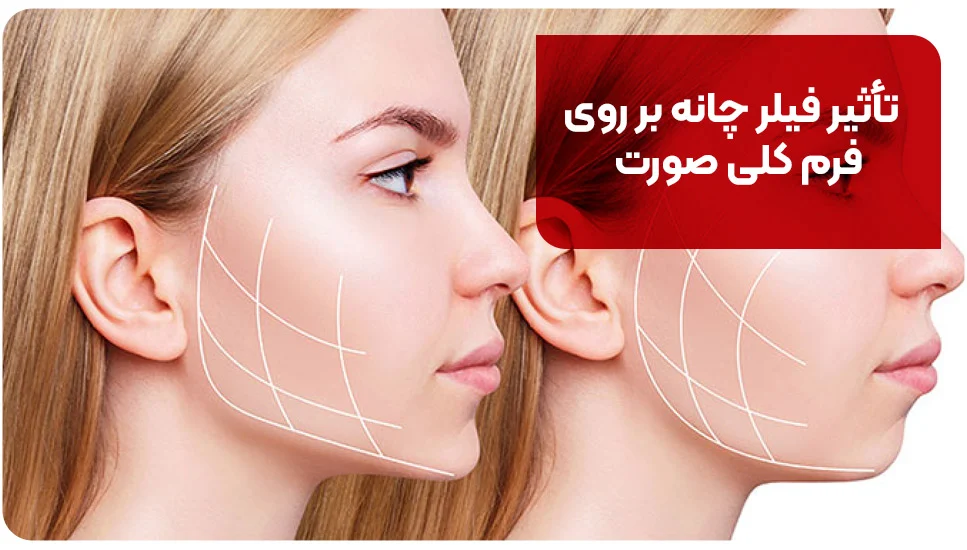 تأثیر فیلر چانه بر روی فرم کلی صورت