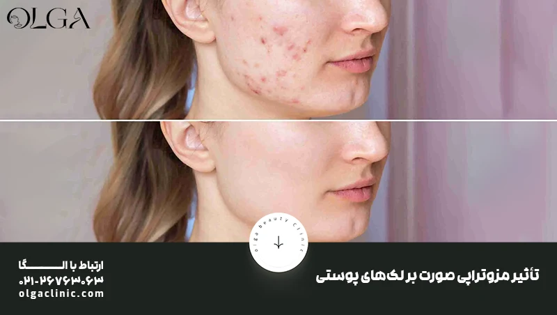 تعداد جلسات لازم مزوتراپی برای لک صورت