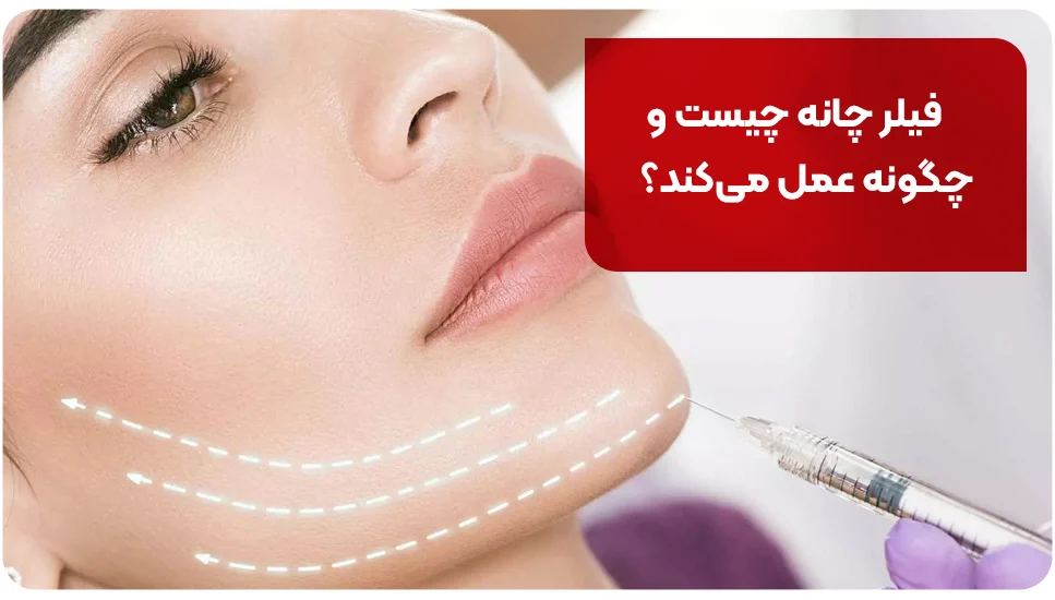فیلر چانه چیست و چگونه عمل میکند؟